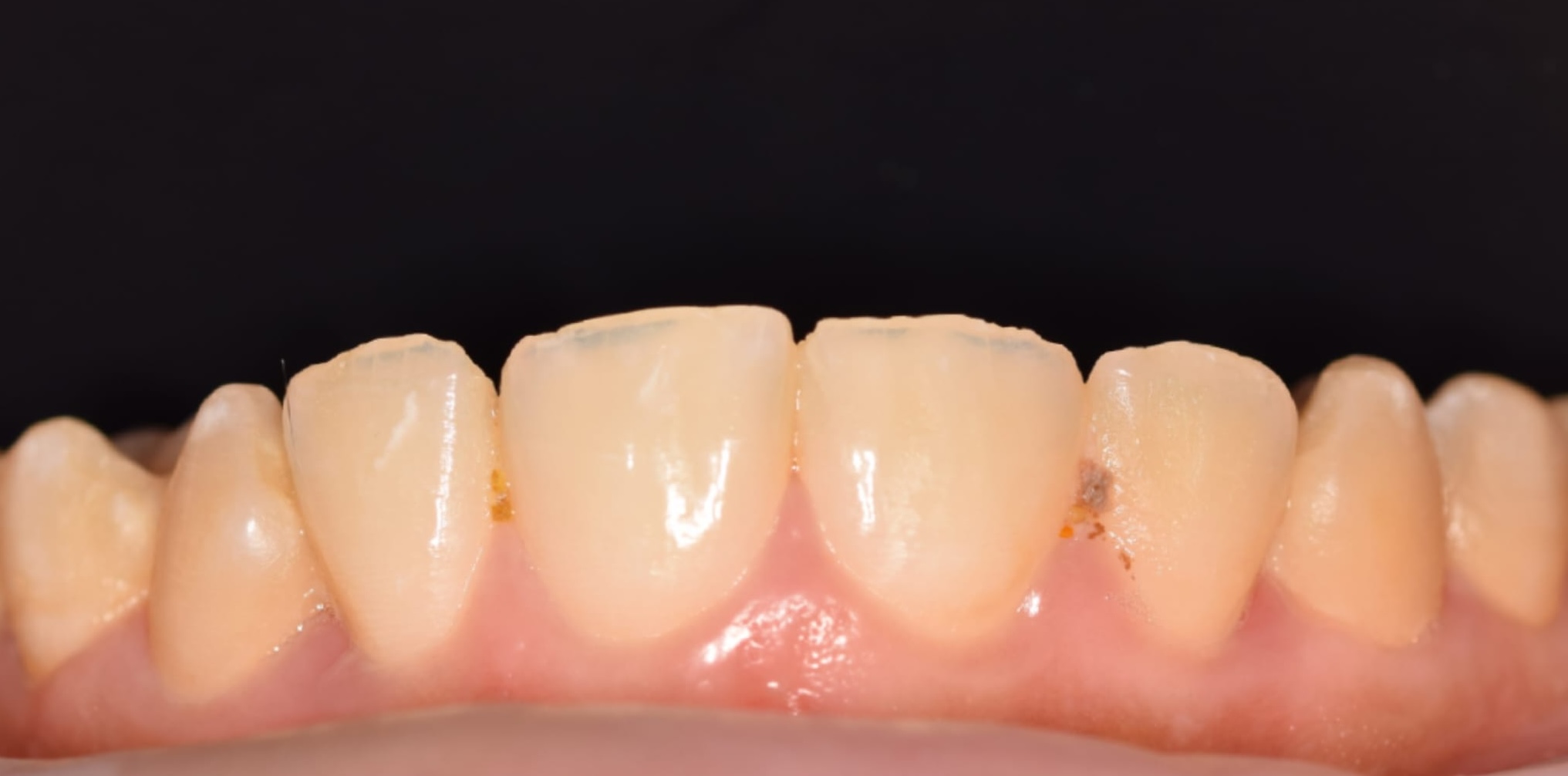 Teeth before whitening treatment