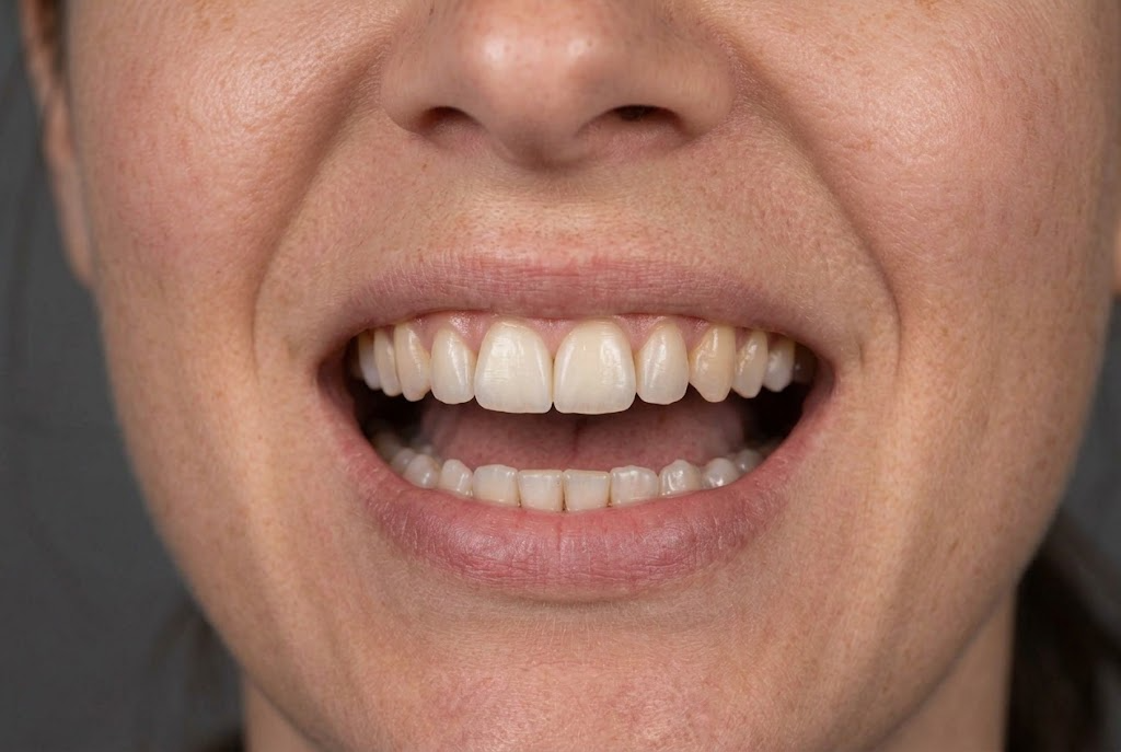 After: Composite bonding smile restoration